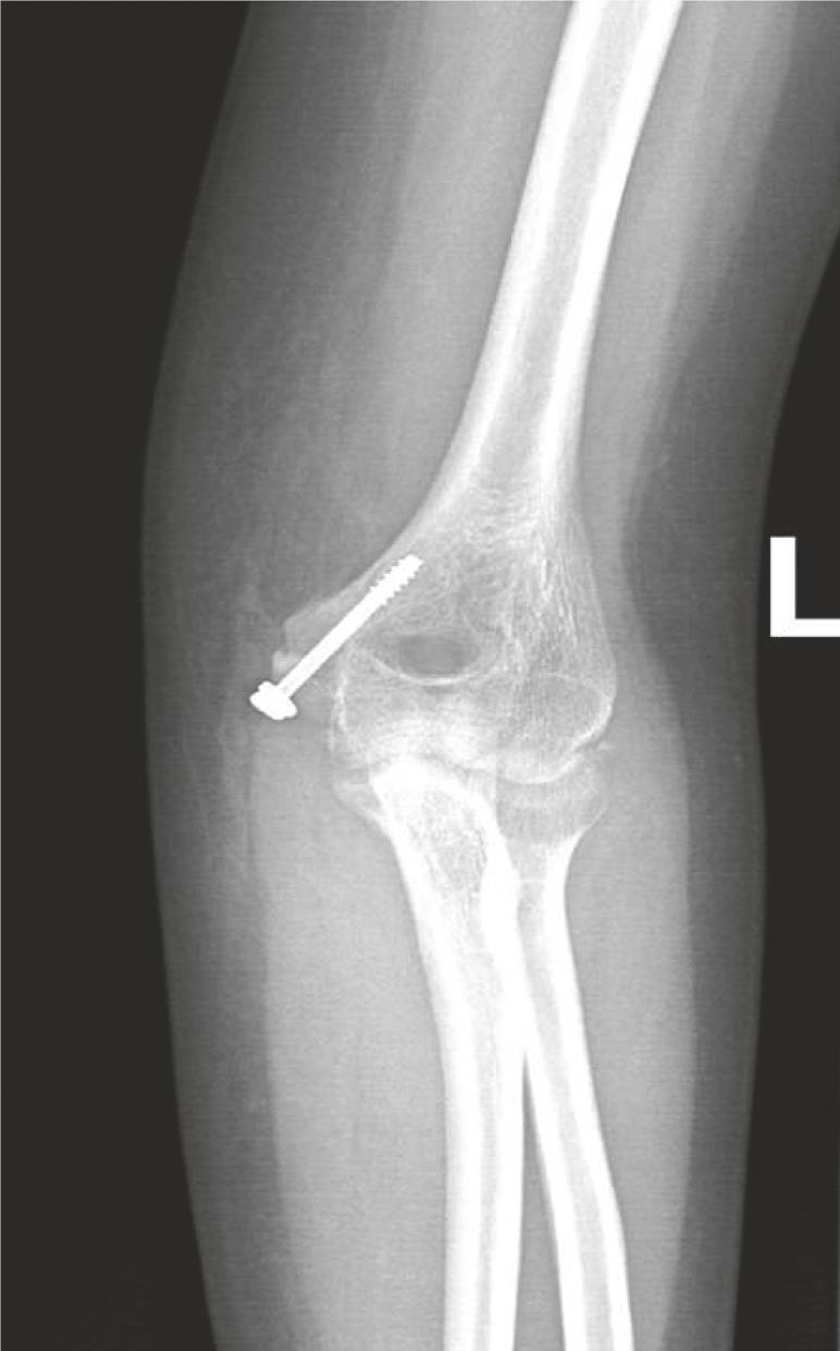 Figure 6: Lateral and anteroposterior radiographs of the left elbow joint 12 weeks postop showing union of the