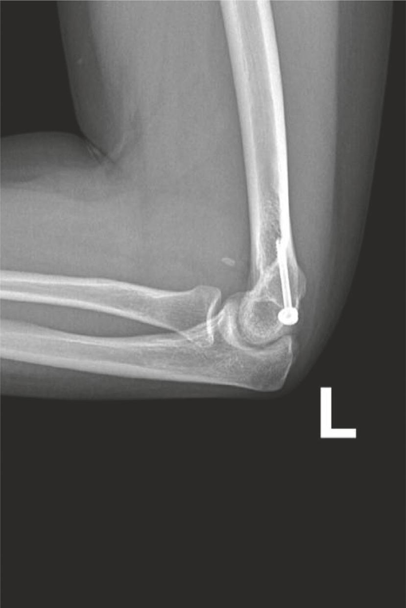 Anterior and lateral ossifications seen indicate possible partial ligamentous injury that calcified with time