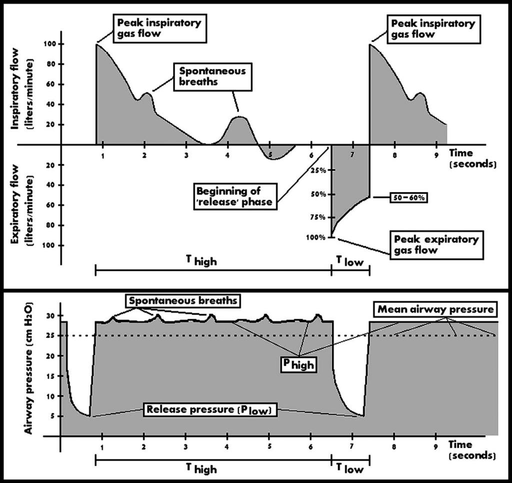Review of Open-Lung Ventilation / Stawicki et al 225 Figure 5. Pressure versus time and flow versus time graphs seen with airway pressure release ventilation.