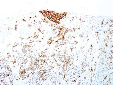 74 A Robson Figure 2. Langerhans cell hyperplasia may be confused with Pautrier microabscesses; expression 