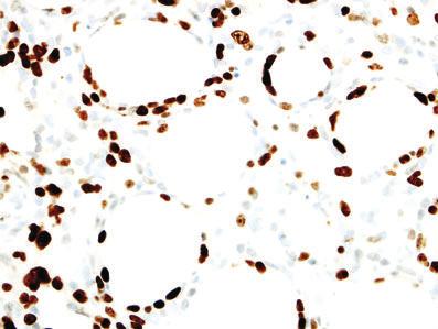 78 A Robson A B C D Figure 5. By definition, the cells of subcutaneous panniculitis-like T-cell lymphoma (SPTCL) are CD8+ (A), which highlights the adipocyte rimming by neoplastic cells.