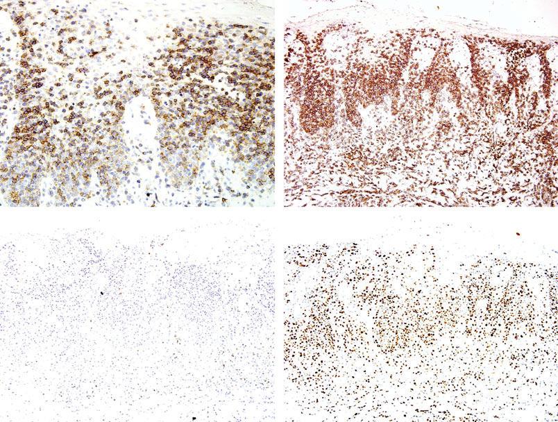 Immunocytochemistry, cutaneous lymphoma 79 A B C D Figure 6. Berti s lymphoma typically has a CD8+ (A) CD45RA+ (B) CD2) (C) phenotype with a high intraepidermal proliferative fraction (D).