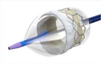 single-handed control On-balloon design Streamlines the procedure 14F Axela Sheath for all valve sizes Next generation