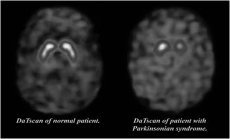 Parkinsonism REM sleep behavior disorder Neuroleptic sensitivity Occurs on a spectrum with Parkinson s disease When dementia precedes PD -> LBD When PD precedes dementia -> PDD, PAD Pathologic