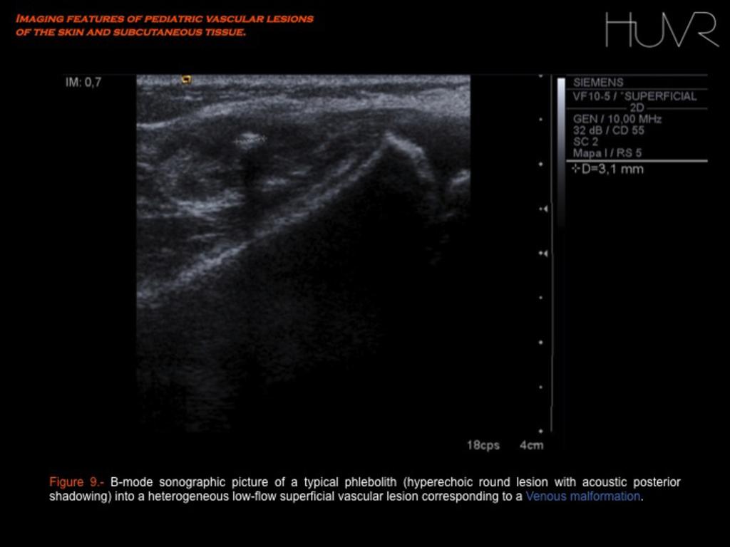 Fig. 9 On Doppler US analysis, venous malformations generally show low vascular density with slow and turbulent flow, being more frequently monophasic (78%) than biphasic (6%) or absent (16%) [1, 2].