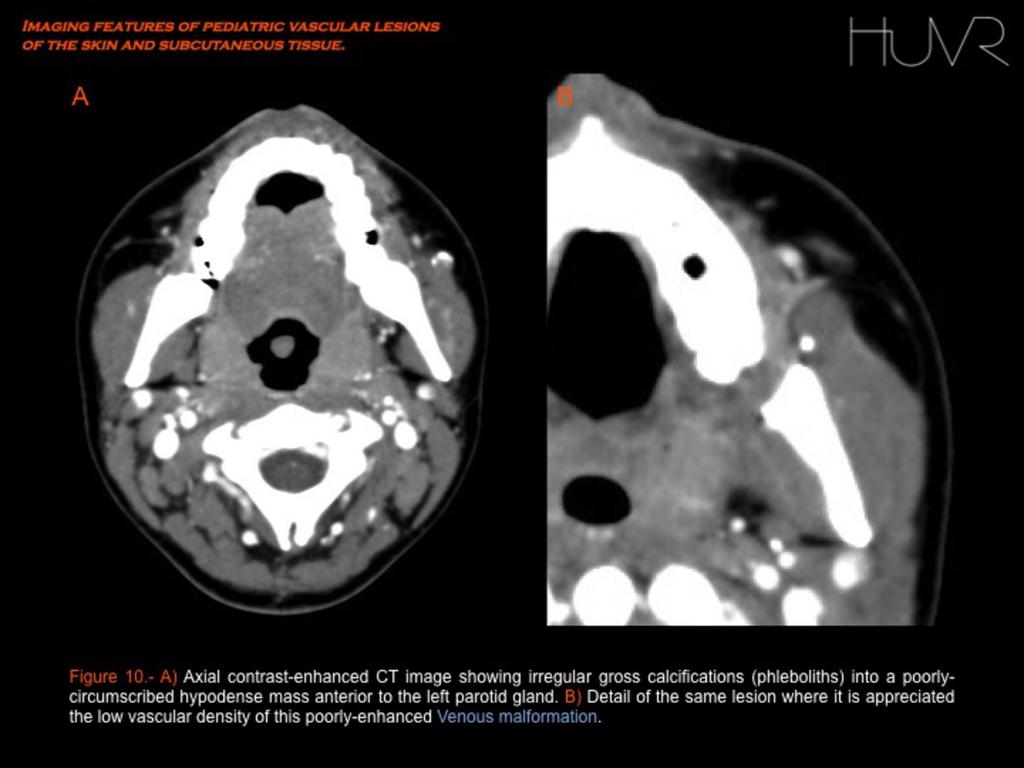 Fig. 10 MRI MR imaging is considered to be the best single imaging modality to characterize the lesion as distinct from the high flowed ones and for assessing its extent and relationship to adjacent