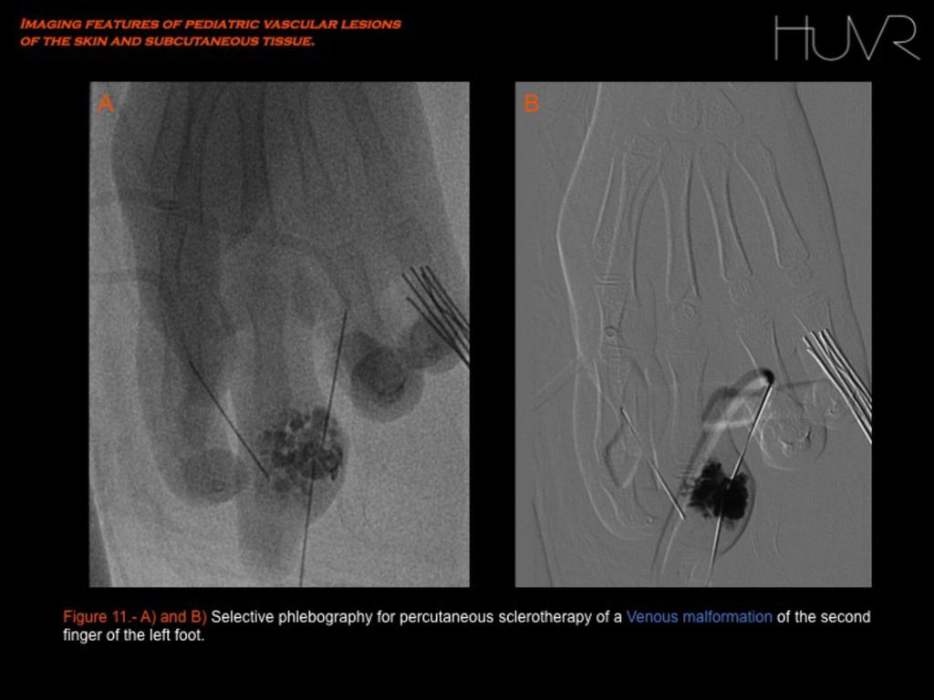 Conventional angiography Sometimes limb phlebography by direct puncture of the lesion is still used to plan sclerotherapy procedures.