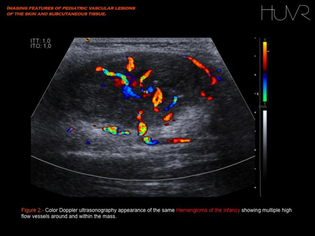 Hemangiomas are fast-flow lesions with numerous high flow vessels around and within the soft tissue mass. Fig.