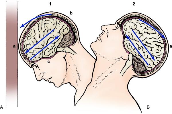 Concussion A concussion is caused by a blow to the head that causes the brain to hit up against the bony ridges on the inside of the skull. The nerves can be stretched or torn.
