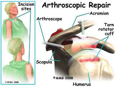 Today, it is much more common to repair tears of the rotator cuff using the arthroscope. surrounding the joint, leading to faster healing and recovery.