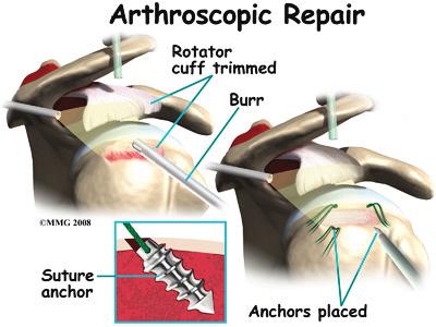 Once any degenerative tissue and bone spurs are removed, the torn rotator cuff tendon can be reattached to the bone. Special devices have been designed to reattach these ligaments.