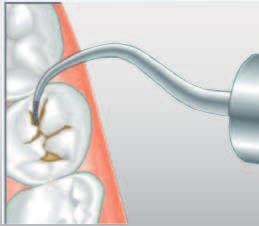 KaVo SONICflex tips overview - Minimally-invasive surgery - SONICflex seal tip no.