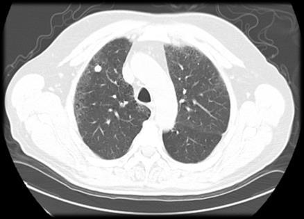 A need and opportunity in diagnosing lung cancer The Problem Current Options Potential Opportunity CT scans Biopsy Surgery $750M-$1.5B ** 1.