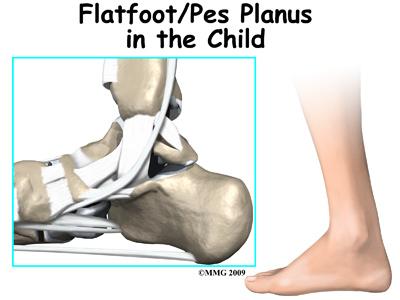 Introduction Flatfeet (also known as pes planus) describes a condition in which the longitudinal (lengthwise) and/or medial (crosswise) arches of the foot are dropped down or flat.