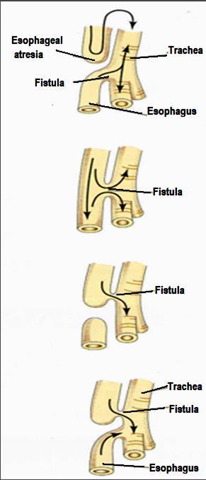Developmental anomalies Tracheoesophageal Fistula An abnormal passage between the trachea and esophagus.