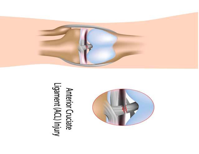 Surgical reconstruction involves replacing the torn ACL with a graft. The most common grafts used are the patellar tendon graft, the hamstring tendon graft, and an allograft (cadaver).