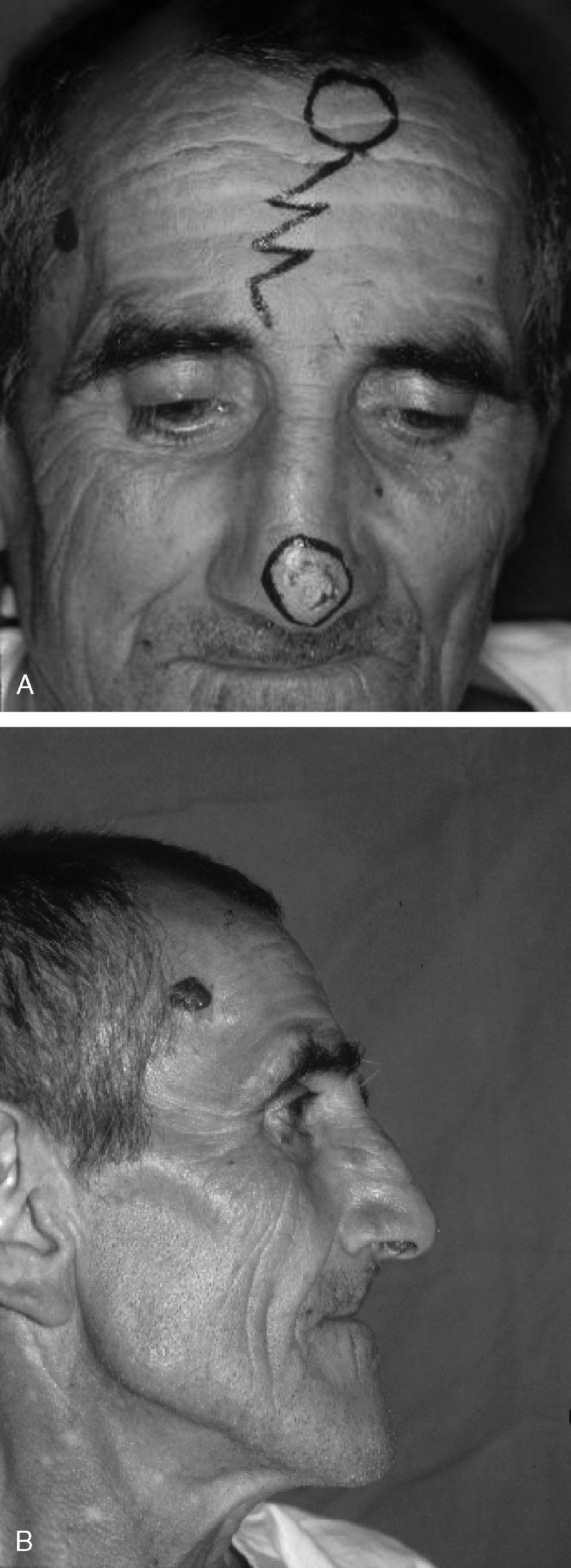 CLINICAL REPORT A61-year-old patient came to our attention with basal cell epithelioma of the nasal tip.