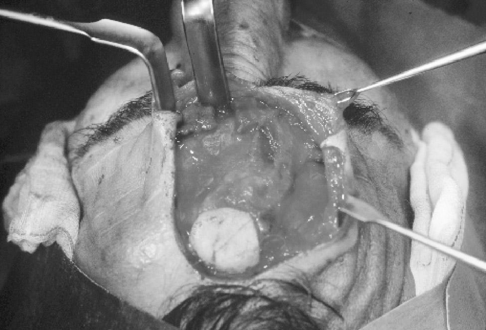 The cutaneous island to be inserted is thinned up to the derma, saving (spearing) the subdermal plexus.