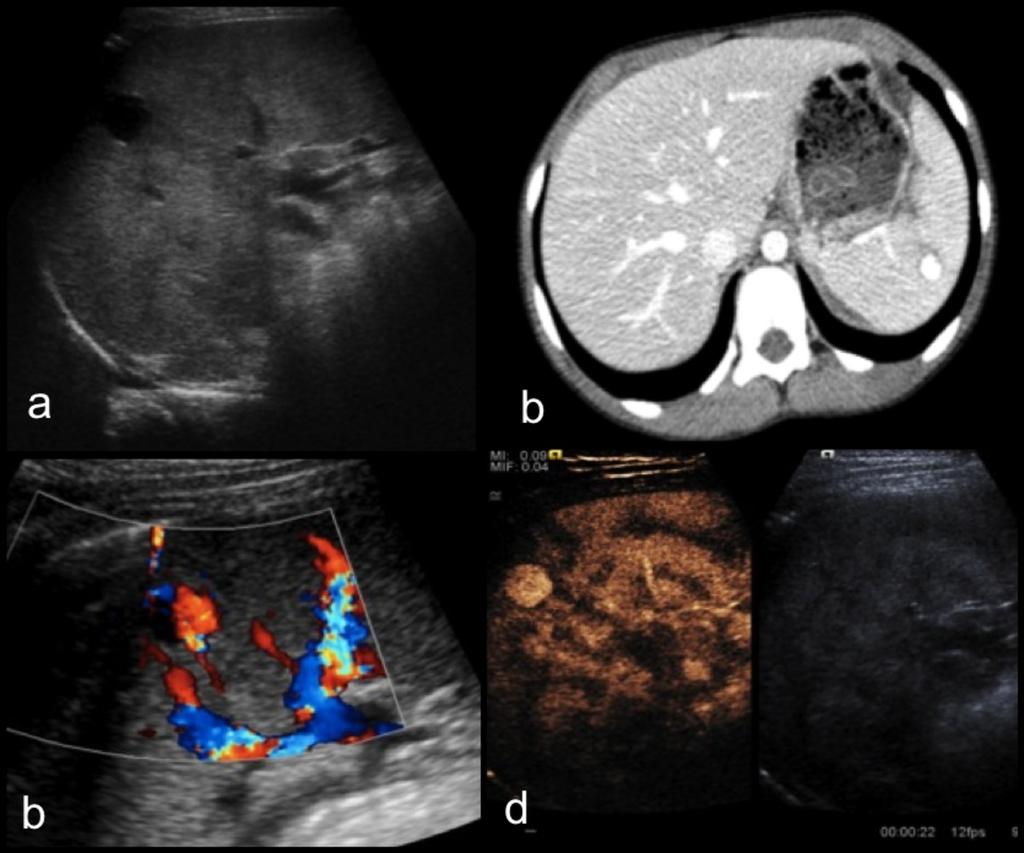 Fig. 1: This patient sustained blunt abdominal trauma and initial CT (b) demonstrated a splenic pseudoaneurysm.