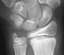 - The history will help you to differentiate between the normal joint and the type 5 fracture.