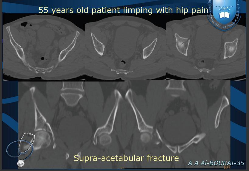 - The fracture of the right iliac