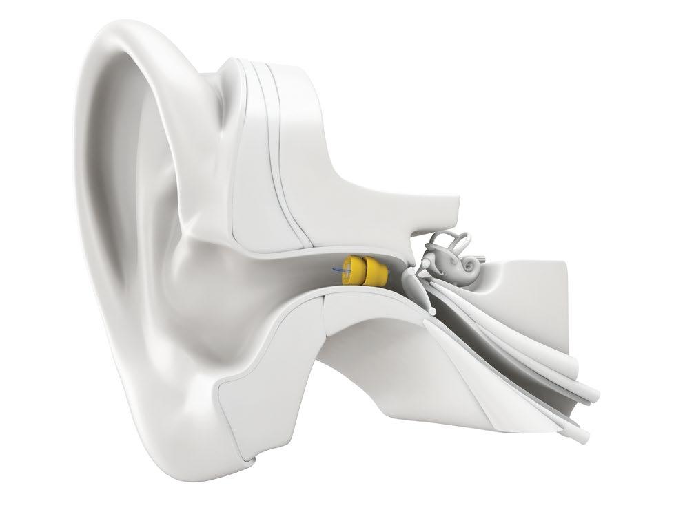 A natural listening experience Micro-engineering at its best While traditional hearing aids capture and process sound outside of the ear, Lyric uses the natural anatomy of the ear to amplify and give