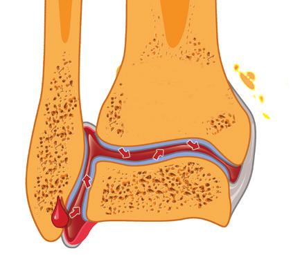 If bleeding continues, it may stretch the joint capsule and move the bone