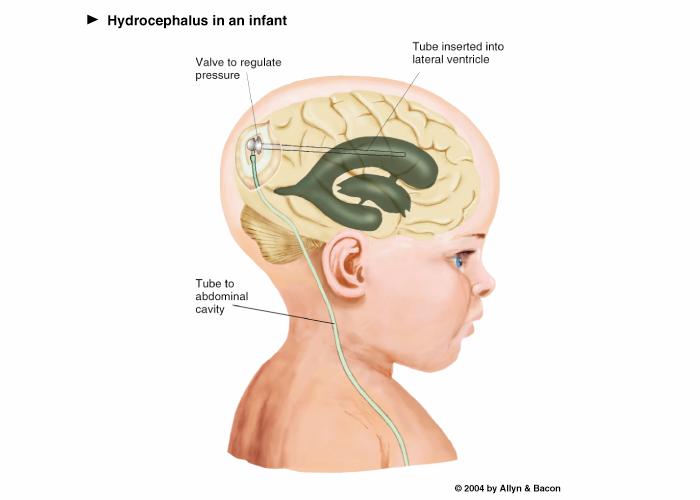 Basic Features of the Nervous System Obstructive hydrocephalus: A condition in which all or some of