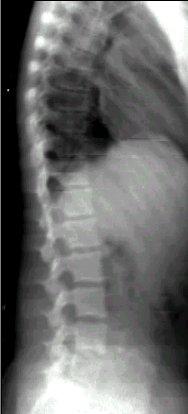 Vertebral Fracture Assessment VFA is a low dose technique with doses reported to be from 1 to