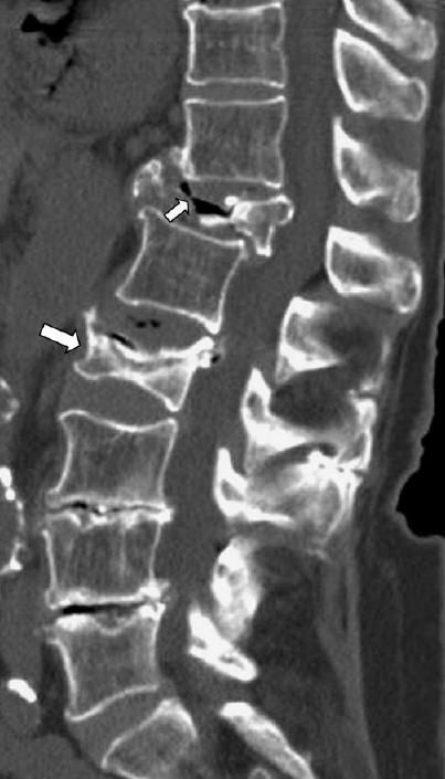 Multi-Detector CT Fracture assessment of the spine is possible without any additional radiation burden by routinely performing sagittal reformations in 3D CT of the