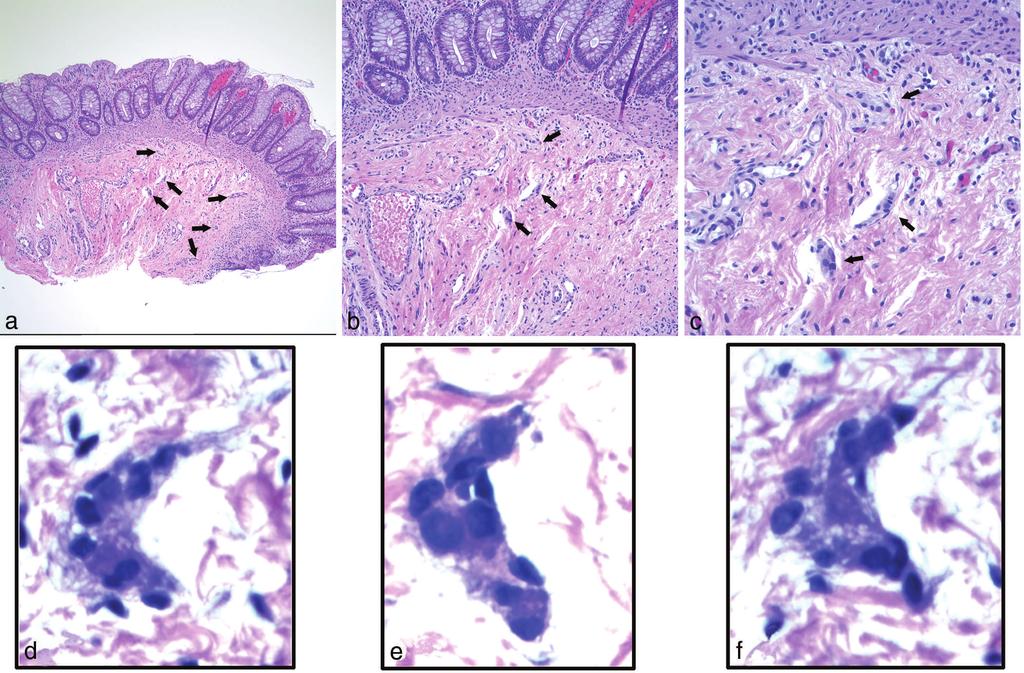 Identification of even sparse numbers of GCs, even if immature, in a suction rectal biopsy specimen is sufficient to exclude HSCR.
