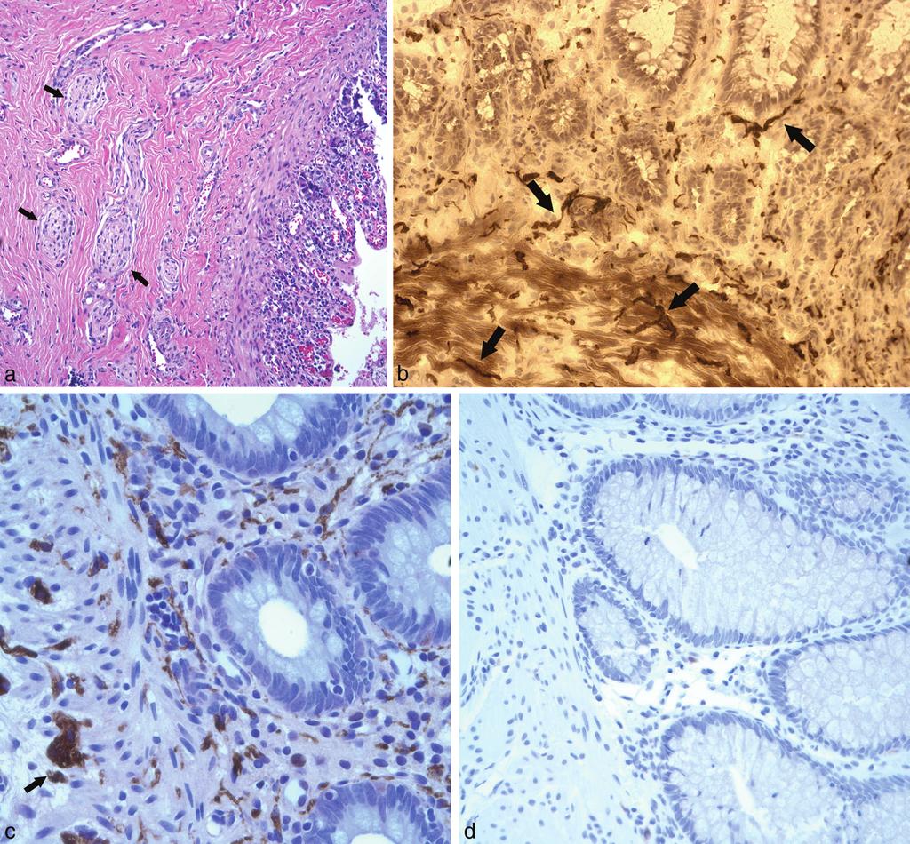 Figure 6. a, Several hypertrophic nerves (.40 mm, arrows) are noted in the submucosa of this suction rectal biopsy specimen.