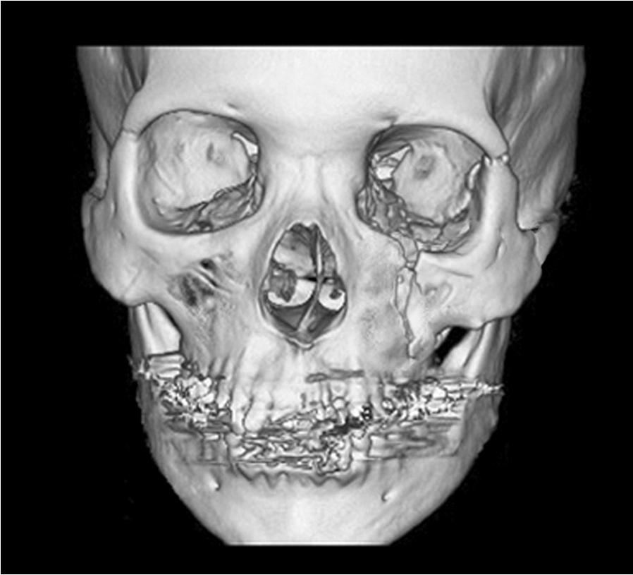 Plastic Surgery: An International Journal 4 (g, h) Shear-Lateral Type. Results In total, the researchers performed 176 operations for facial fracture.