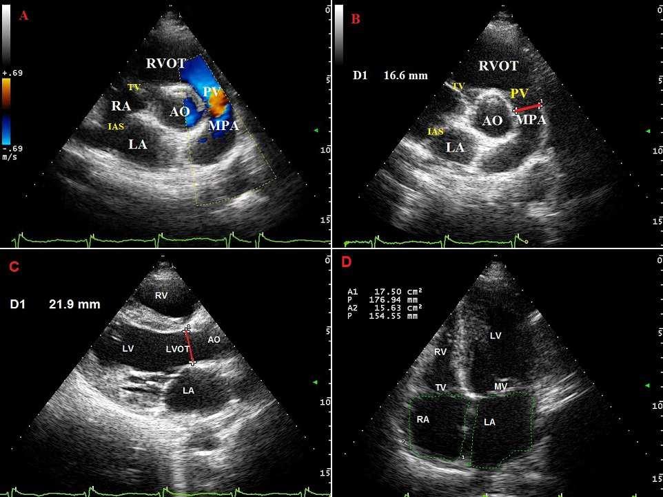 International Journal of Medical Imaging 2014; 2(2): 34-38 35 2. Method Figure 1.Parasternal short axis views at the level of the aortic valve are demonstrated for 3 patients (A to B).