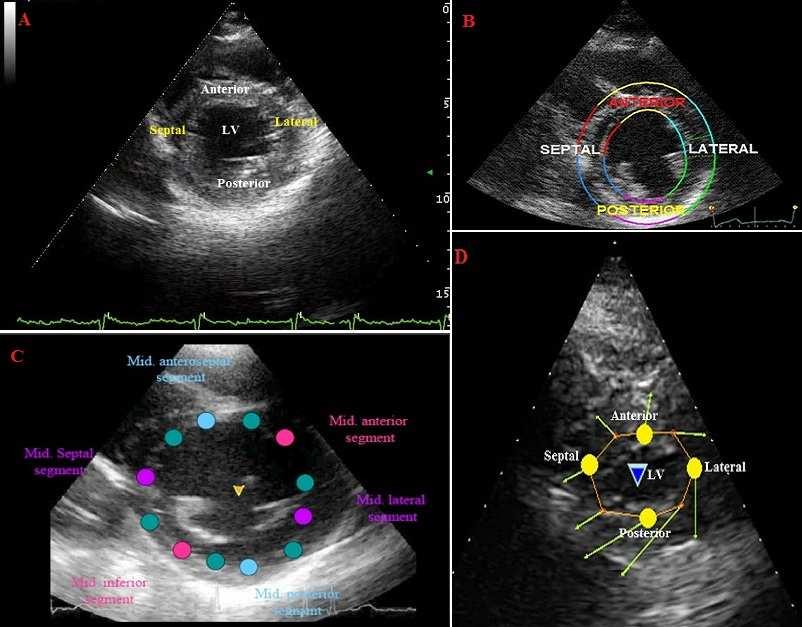 Aortic valve is normal and is in open position(systolic frame) (A). Main pulmonary artery (MPA) size is 16.6 mm that is normal and pulmonary valve is also normal (B).