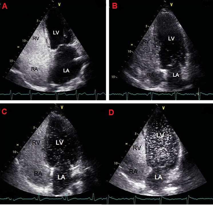 The normal inter-atrial septum illustrates that there is no right to left atrial shunting (ASD). MV, mitral valve; TV, tricuspid valve; ASD, atrial septal disorder (B to D) Figure 7.