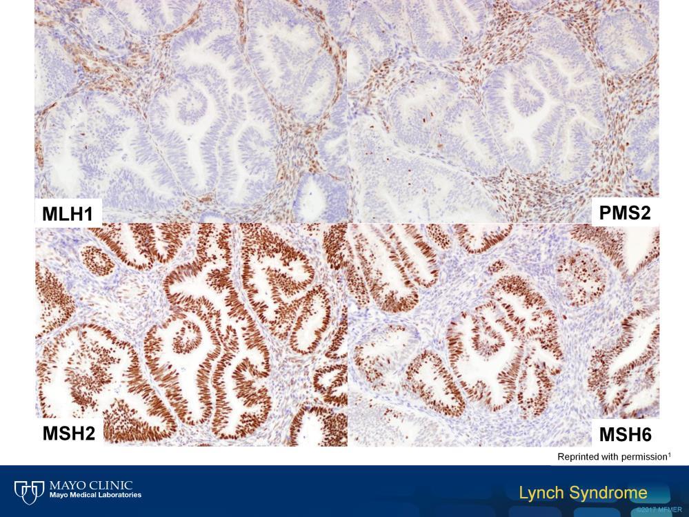 Immunohistochemistry shows loss of MLH1 and PMS2 protein expression and retention of MSH2 and MSH6 staining. The endometrial stroma and scant tumor infiltrating lymphocytes serve as internal controls.