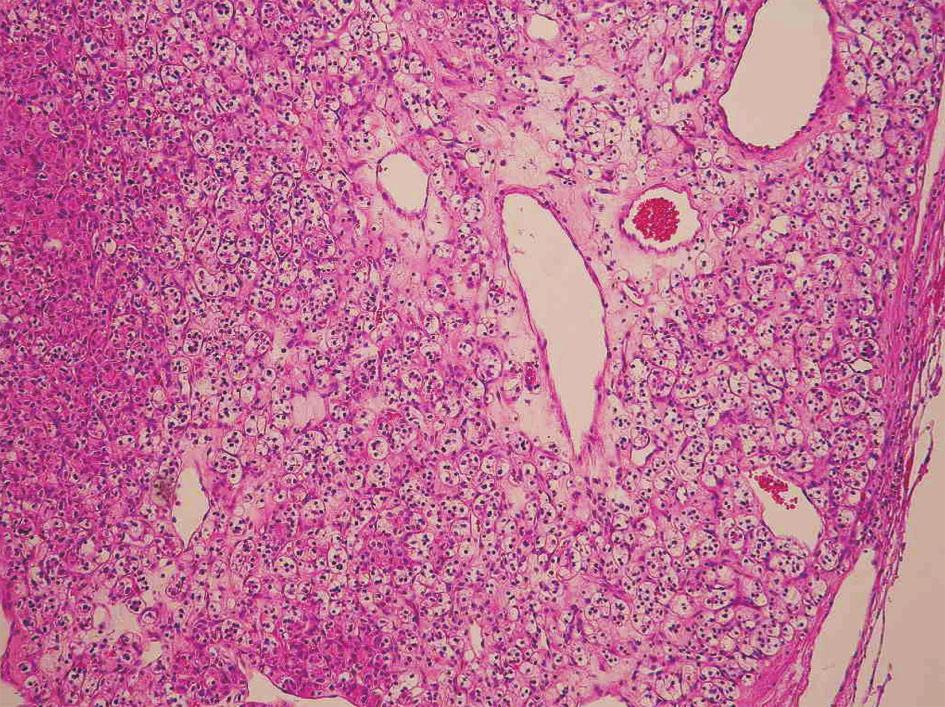 517 Heng-Chang Chuang, et al kidney; microscopic examination revealed clear cell RCC (Fig. 4). The patient received regular hemodialysis and under careful surveillance at this writing. Fig.