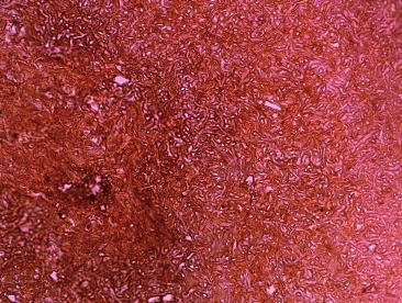 Foto 3. Aspergillus e kogumikud (immunohistokeemiline värving Aspergillus e antikehaga, suurendus 40 korda). Foto 6.