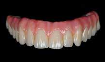 The scope of application ranges from metal and zirconium oxide-supported restorations to