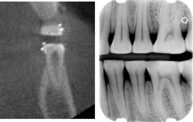 A Mol and A Balasundaram 321 a b Figure 1 (a) Cross-sectional cone beam CT slice through the mandibular left first premolar. The two metal spheres on the lingual surface mark the area of interest.