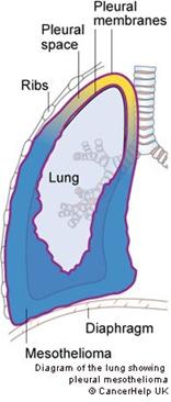 What is pleural mesothelioma? Pleural mesothelioma is cancer of the cells in the lining of the lung. These cells are called mesothelial cells. What is the mesothelium?