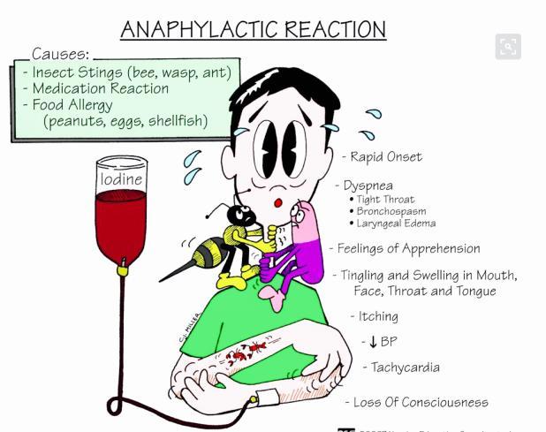 Anaphylactic circulatory shock state resulting from a severe allergic reaction producing an overwhelming systemic vasodilation and relative hypovolemia Causes: -medications such as pcn -insect stings