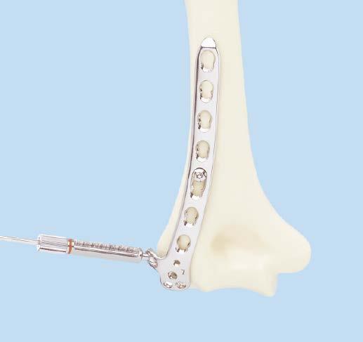 Apply Posterolateral Plate with Lateral Support 1 Determine placement of posterolateral plate Instruments 292.20 2.0 mm Kirschner Wire, 150 mm 323.061 2.