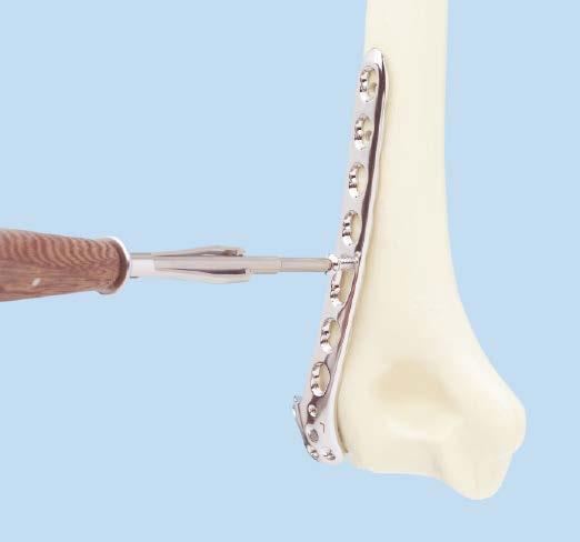 capitulum, and with the lateral support extending over the most protruding tip of the lateral epicondyle, just proximal to the lateral collateral ligament insertion.