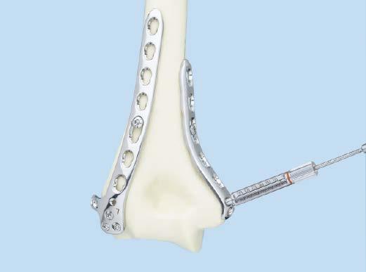 Apply Medial Plate 3 Fix the distal part of the plate to the bone Use a procedure similar to that for the