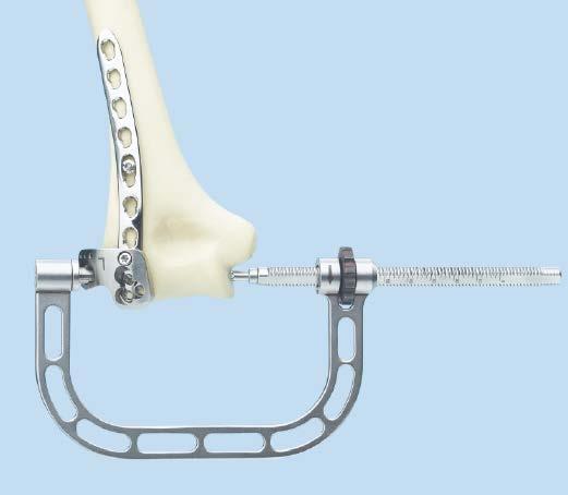available instrument For use with posterolateral plate Can be used to insert independent 3.