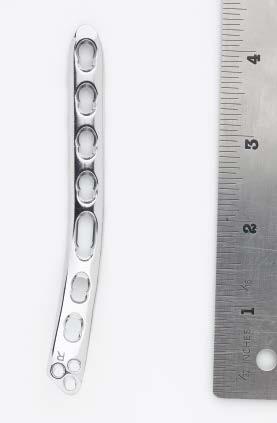 3.5 mm LCP Distal Humerus Plates Additional features Limited-contact design shaft with 3, 5, 7, 9, and 14 Combi