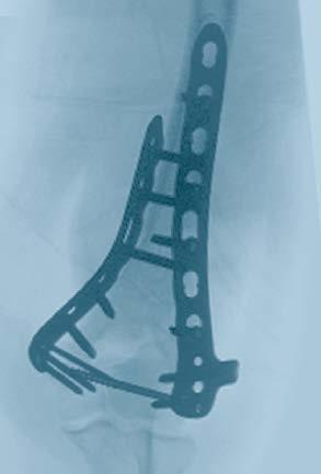 Indications The 3.5 mm LCP Distal Humerus Plates The 3.