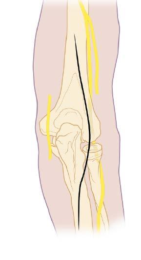 Preparation 1 Patient position The lateral decubitus position is usually chosen.